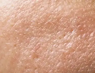 OILY SKIN