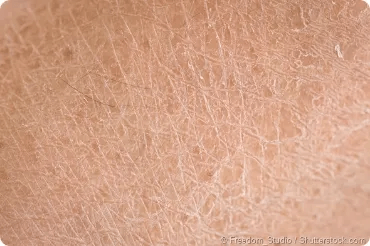 DRY SKIN